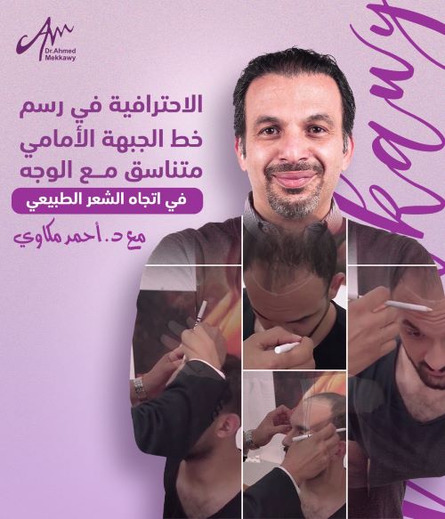 مراكز زراعة الشعر فى مصر